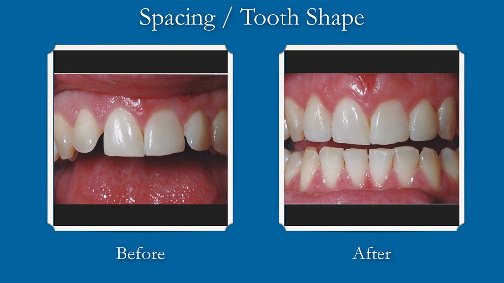 Smile Gallery Patient Before & After Photos Tracy Dental Excellence