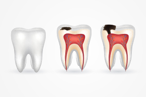 Stages of Cavities