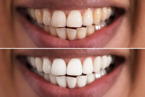 Teeth Whitening Before & After