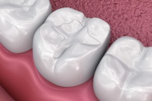 Tooth-Colored Fillings